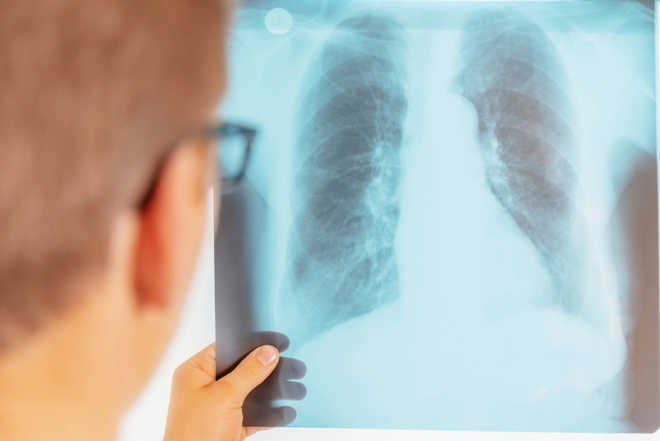 India recorded highest TB cases in 2014: WHO