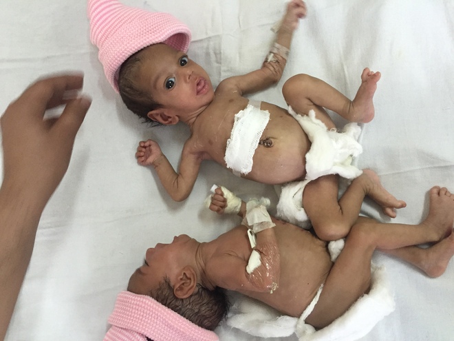 In rare surgery, PGI docs separate conjoined twins