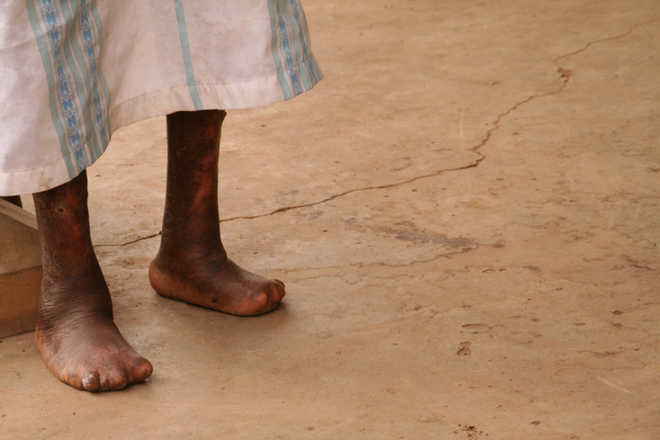 Leprosy can be detected early