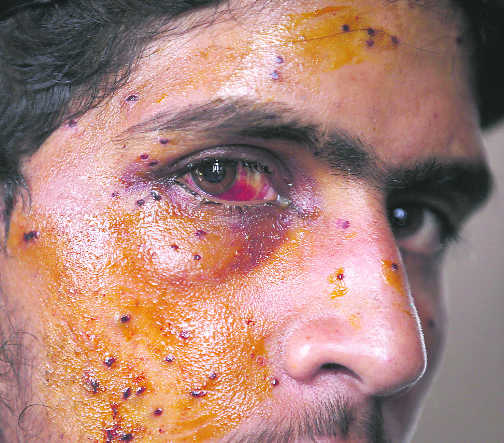 Pellet injuries continue amid voices on ban