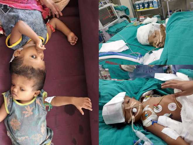 Conjoined twins separated after marathon surgery at AIIMS.