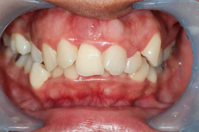 Severe gum disease linked to lung, colon cancers