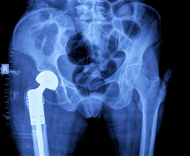 Hip, knee steroid injections may be harmful: Study