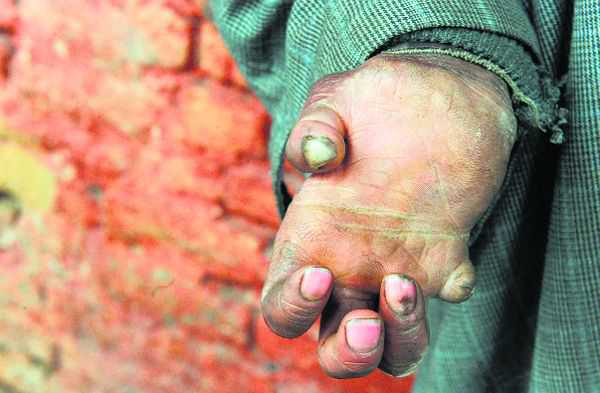 Unfinished business on the leprosy front