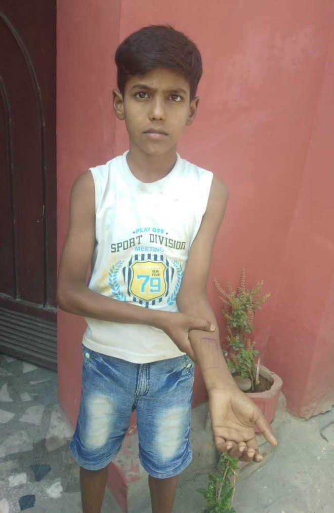 Image result for a private school in Ludhiana had put a stamp on a boy's arm as a reminder