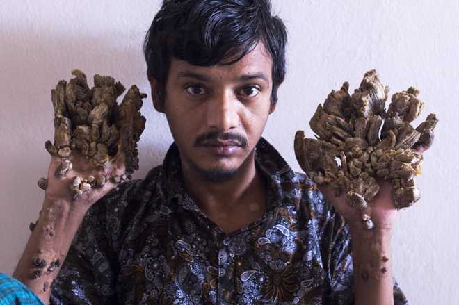 Bangladesh ‘Tree Man’ wants hands amputated to relieve pain